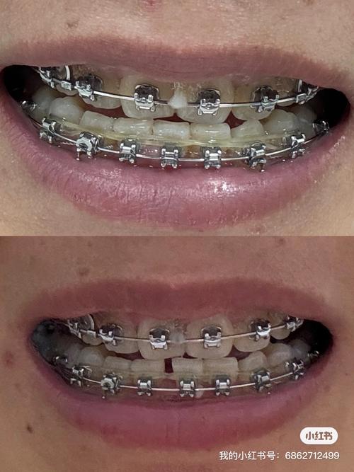 正畸收缝收不好，原因究竟是什么？如何有效解决？-图2