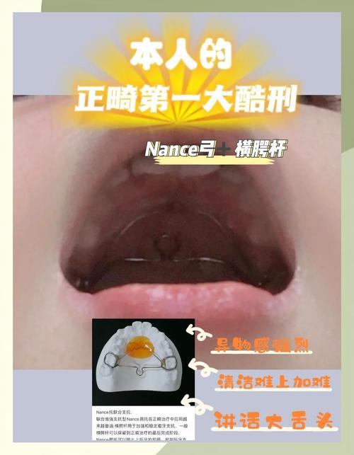 正畸腭弓的作用-图1