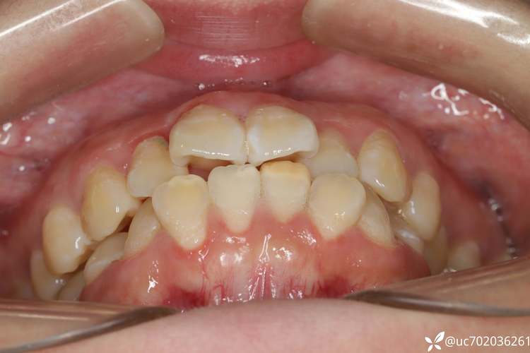 正畸拔3颗磨牙-图1