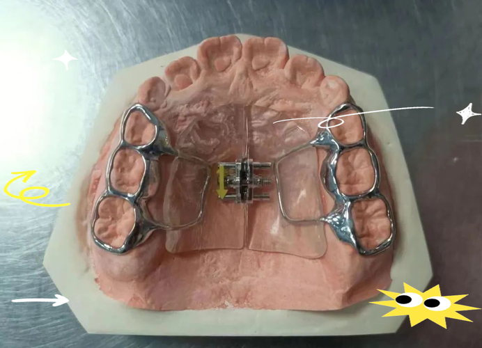 正畸扩弓骑士弓-图1