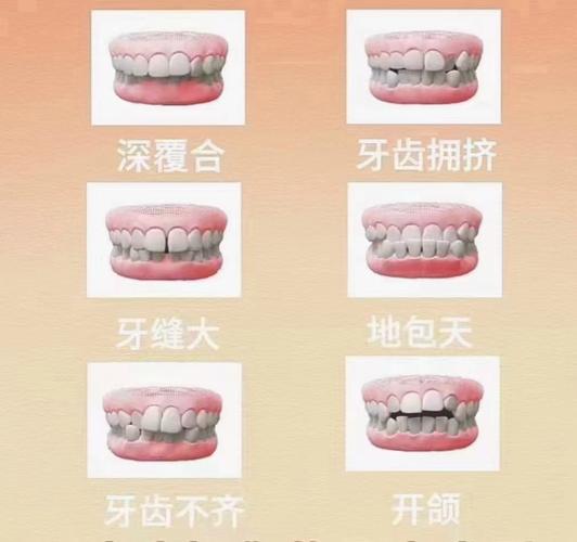 正畸上下牙内收-图1