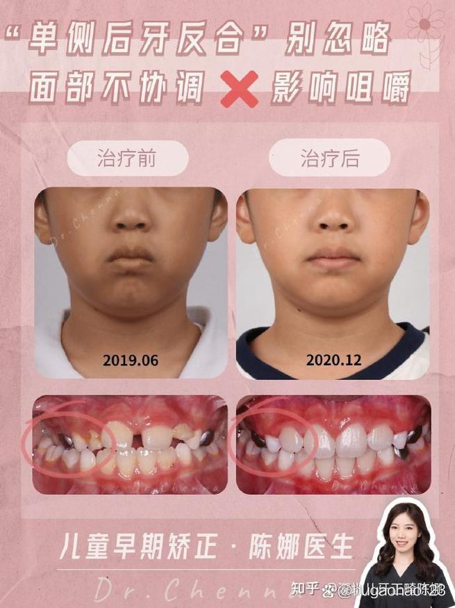 正畸中后牙反合-图2