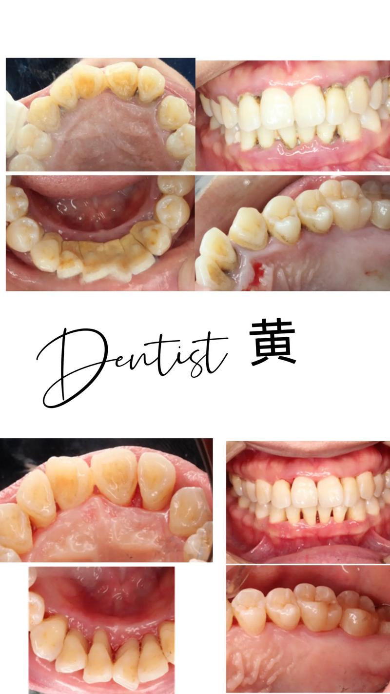 牙周刮治后正畸-图1