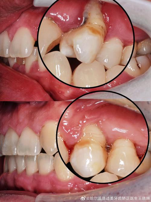 牙周刮治后正畸-图3