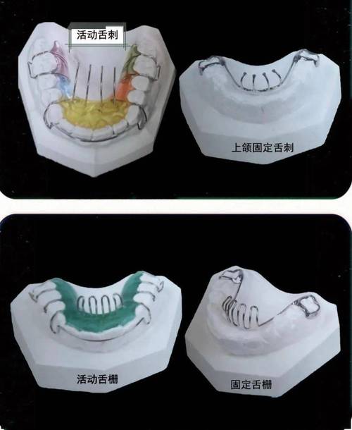 正畸什么是腭网-图2