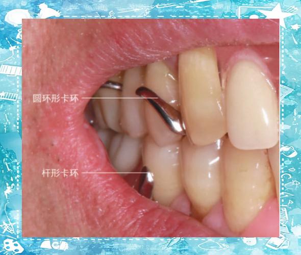 正畸带环摘下来-图1