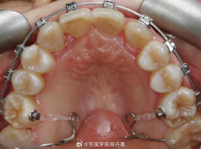 正畸各种弓弯制-图1