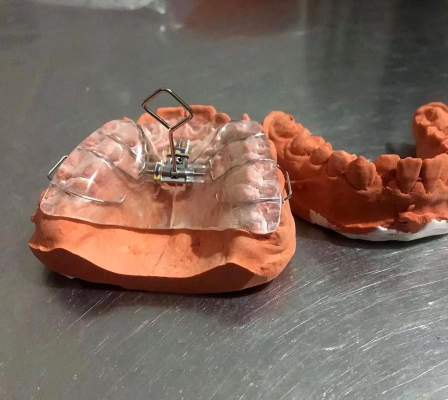 正畸新型扩弓器-图2