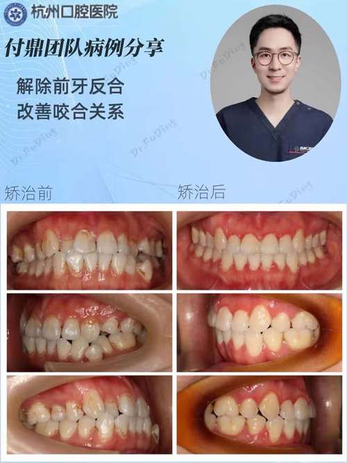 天包地正畸手术-图1 天包地正畸手术-图1