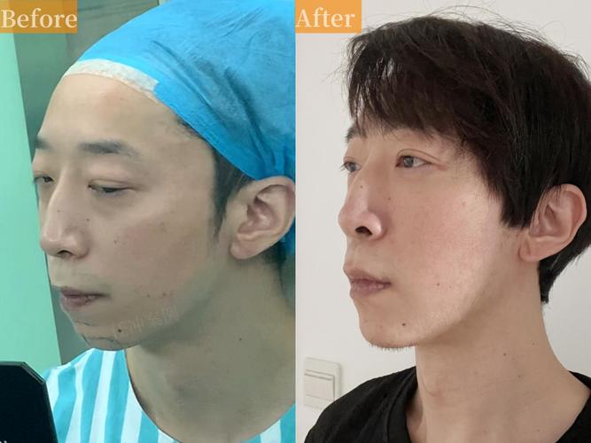 正畸会改变下巴-图2