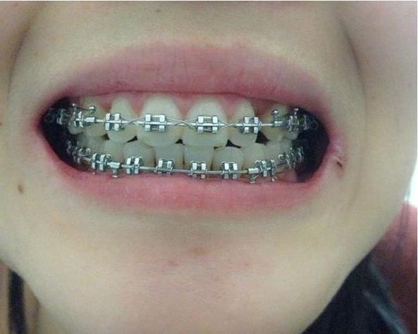 正畸端部钢丝刮伤口腔,原因何在?如何有效处理?-图3 正畸端部钢丝刮伤口腔,原因何在?如何有效处理?-图3