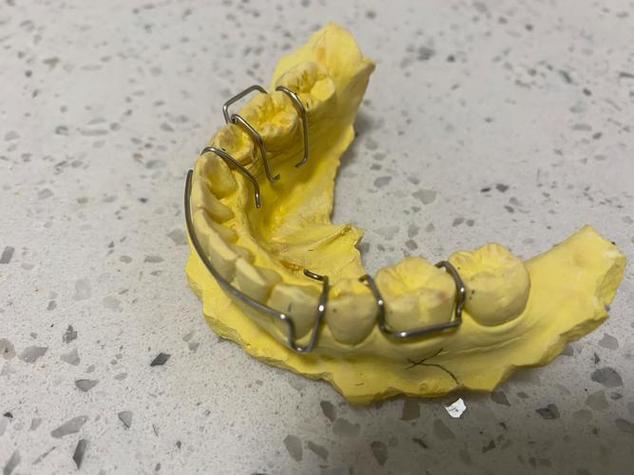 正畸端部钢丝刮伤口腔,原因何在?如何有效处理?-图2 正畸端部钢丝刮伤口腔,原因何在?如何有效处理?-图2