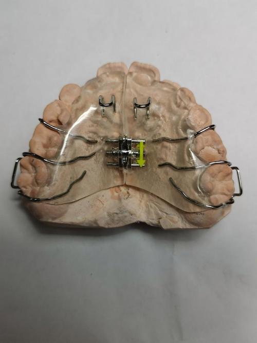 正畸弹簧扩弓器有何作用？使用方法与注意事项有哪些？-图1