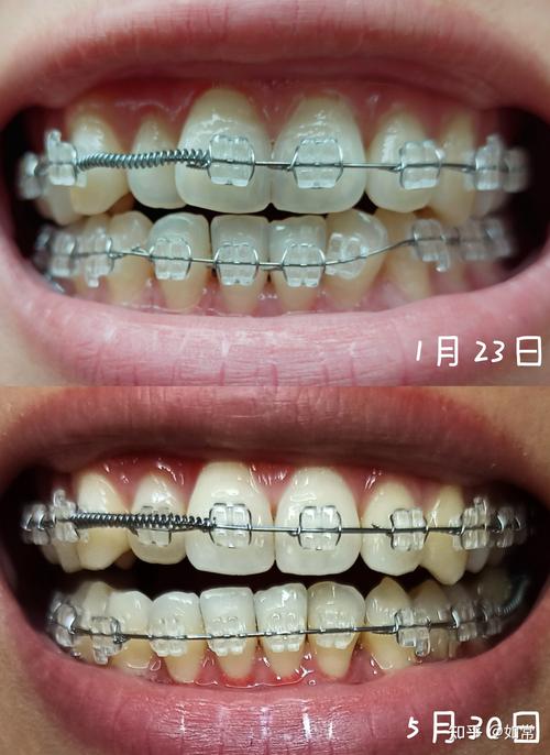 5月15日正畸，当天有哪些注意事项？-图2