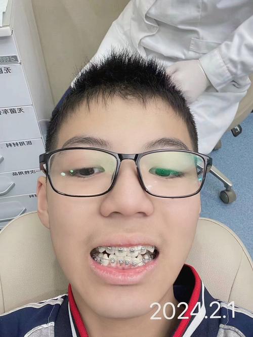 5月15日正畸，当天有哪些注意事项？-图3