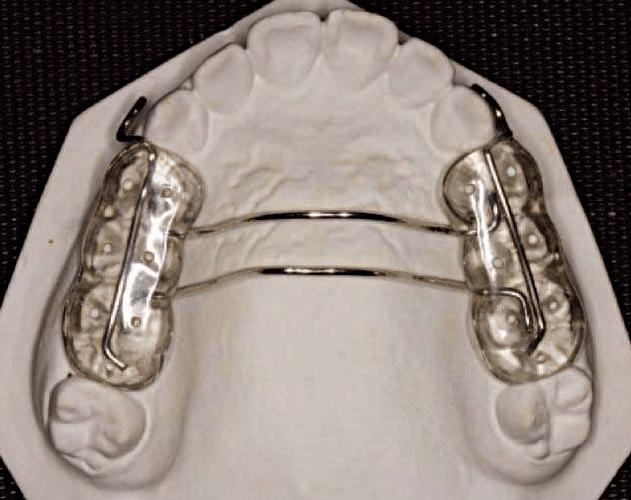 正畸口内阻挡臂-图2 正畸口内阻挡臂-图2