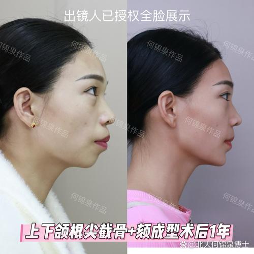 先颏成型后正畸-图1 先颏成型后正畸-图1