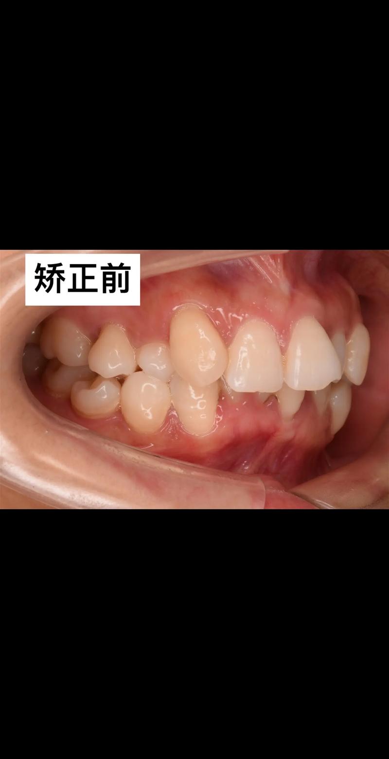 正畸扩后牙间隙-图1