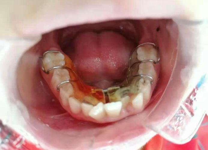 正畸后牙齿为何会斜？是矫正失败还是正常反弹？-图2