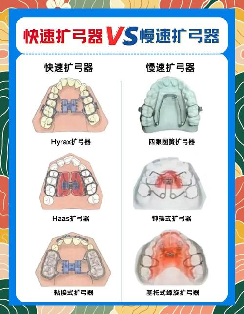 正畸扩弓器分类-图1