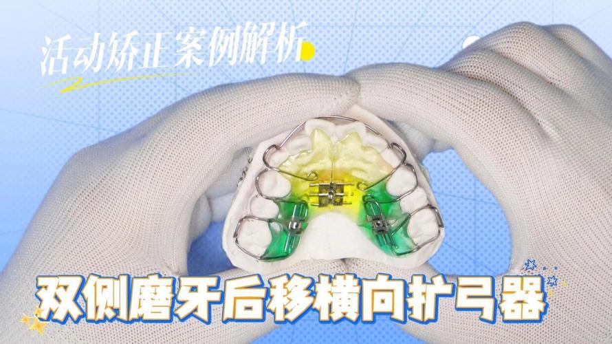 正畸扩弓器分类-图3
