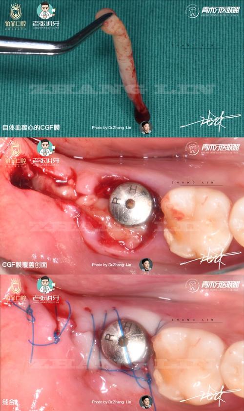 正畸种植钉取出-图1