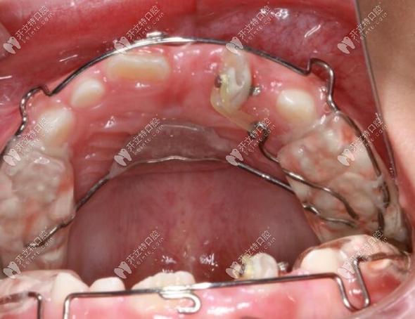 扭转牙正畸治疗-图1
