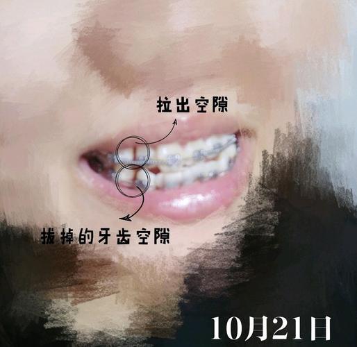 正畸牙齿带弹簧-图1