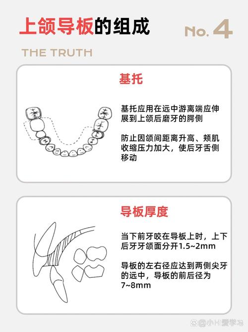 正畸导板的作用-图1 正畸导板的作用-图1