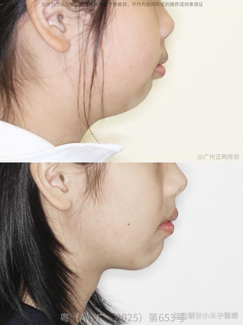 下巴短口腔正畸-图1 下巴短口腔正畸-图1