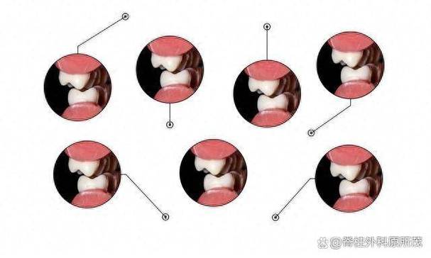 正畸时夜间磨牙-图1