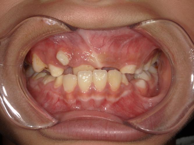 异位牙3 正畸-图1