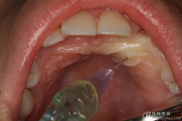 正畸闭合开窗术-图2 正畸闭合开窗术-图2