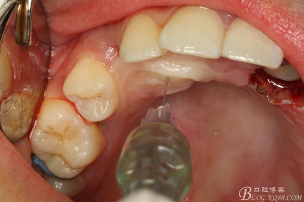 正畸闭合开窗术-图1 正畸闭合开窗术-图1