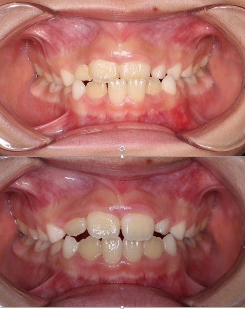 正畸中整体移动-图2