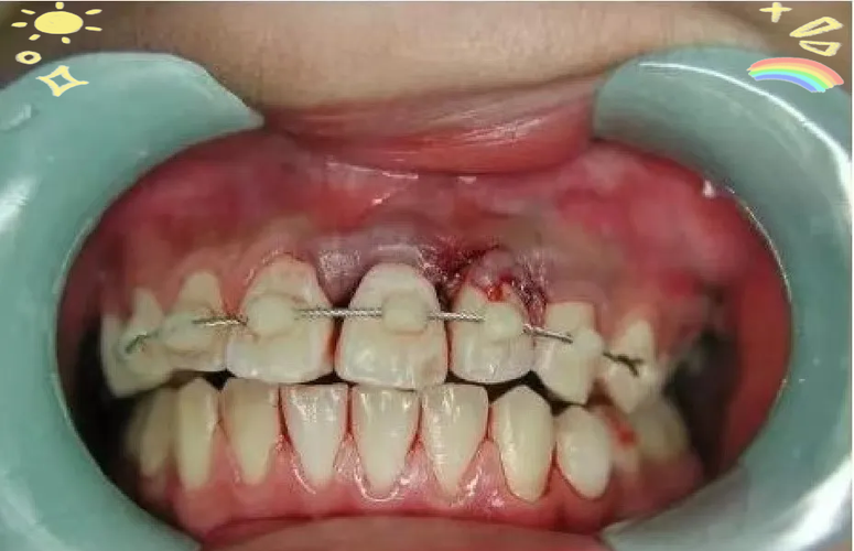 正畸结扎丝松动怎么办？会影响矫正效果吗？-图2