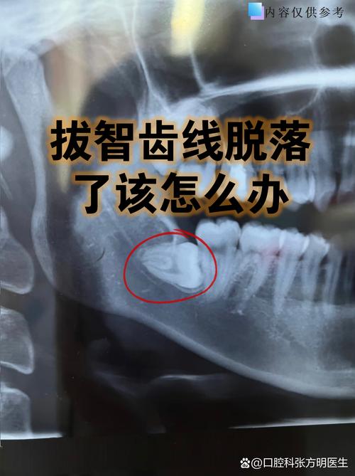 牙齿矫正需要拔掉智齿-图2