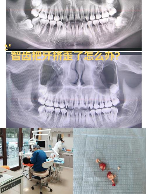 牙齿矫正需要拔掉智齿-图3