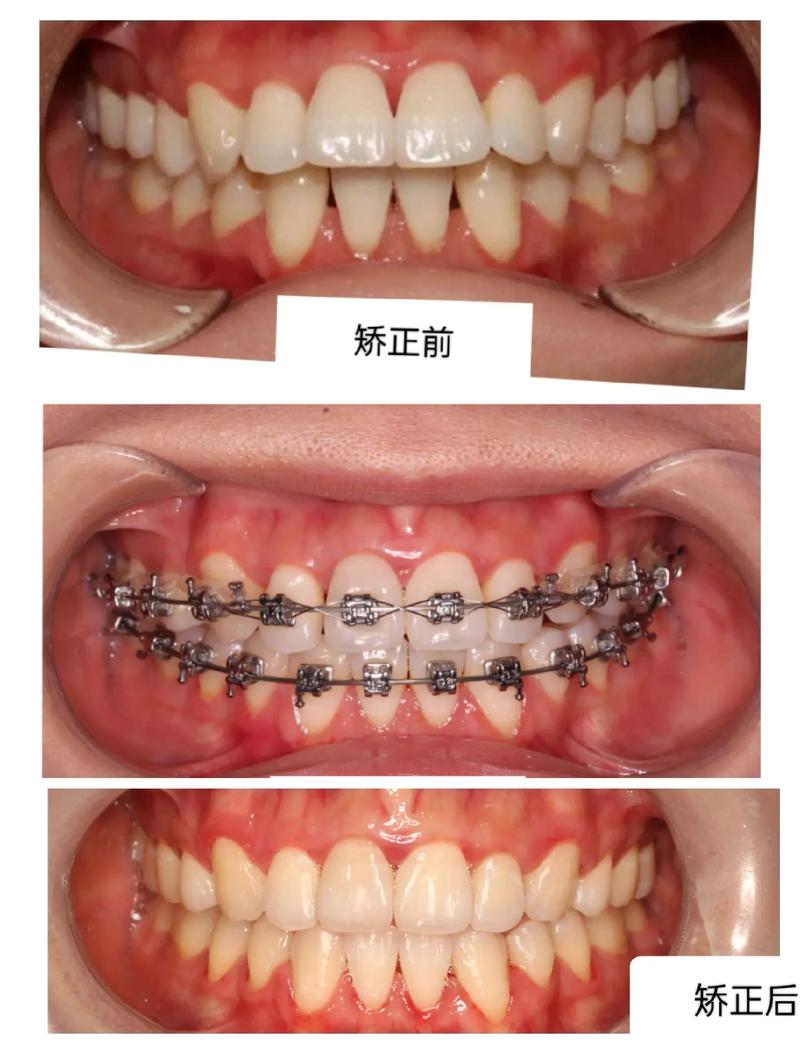 牙齿矫正前后图片对比-图3