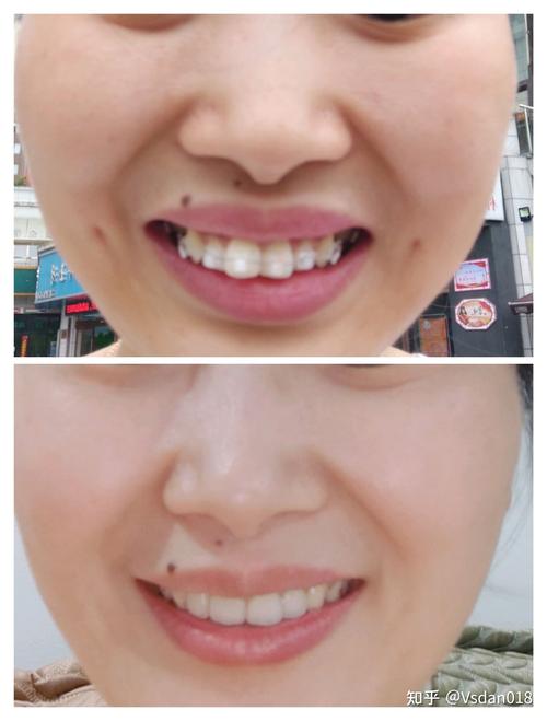 矫正后老了牙齿会松吗？-图2