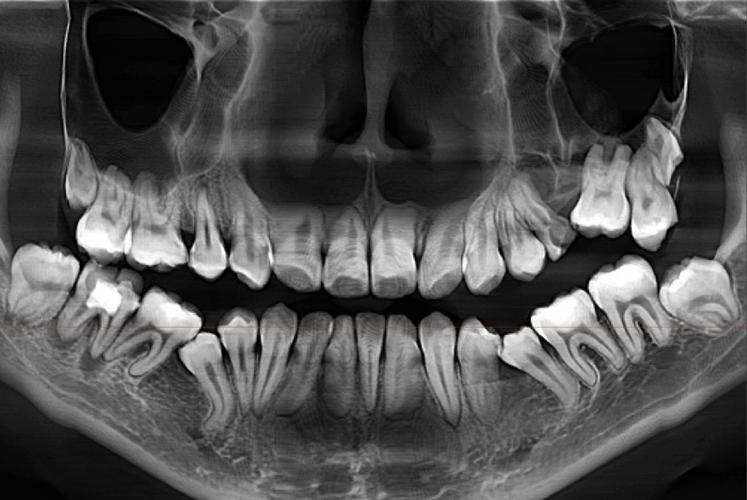 矫正牙齿为啥要拍片子？这些检查到底有必要吗？-图3