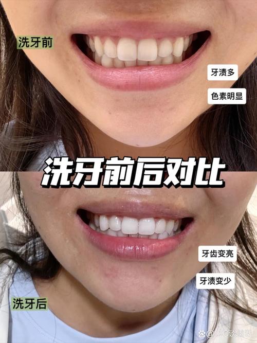 牙齿矫正完可以洗牙吗-图3