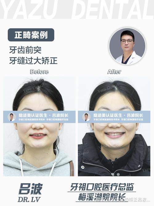 牙齿缝隙大需要矫正吗-图1