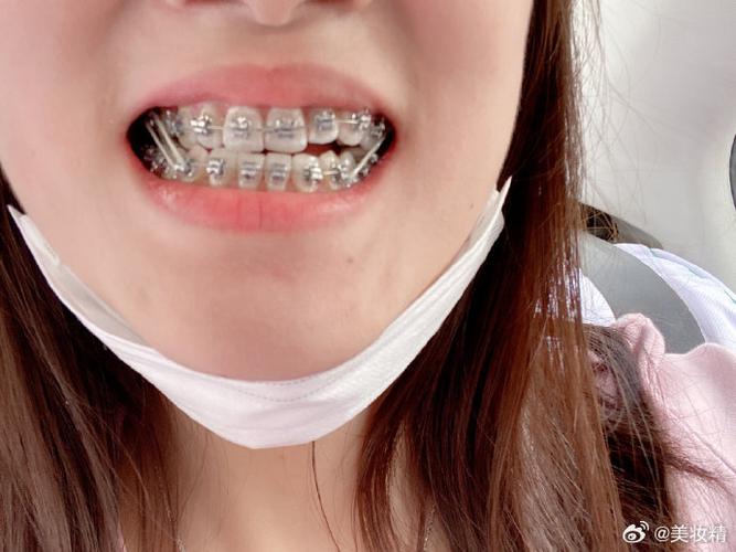 厦门第二医院牙齿矫正效果如何？价格贵不贵？医生靠谱吗？-图2