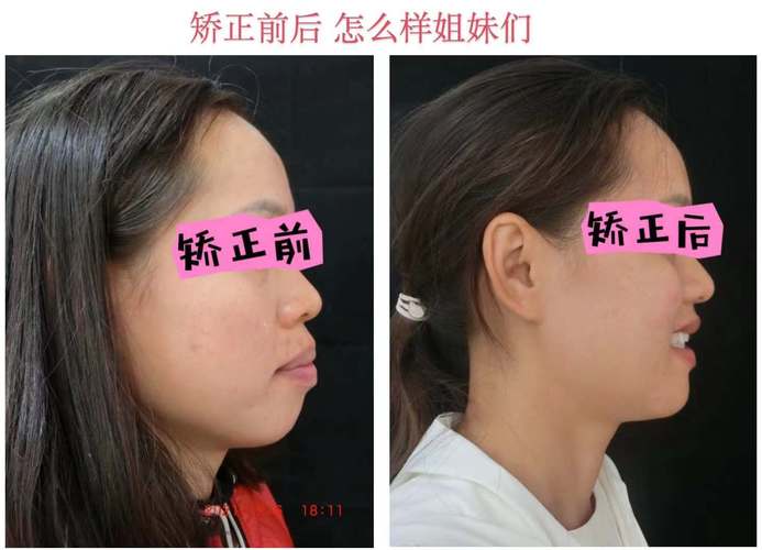 矫正完牙齿后对比照片-图3