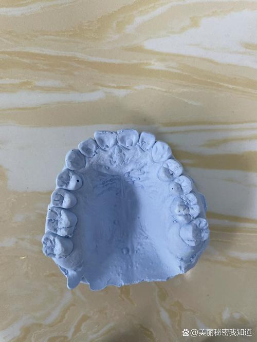 牙齿矫正取模后的牙模，患者能带走吗？-图2