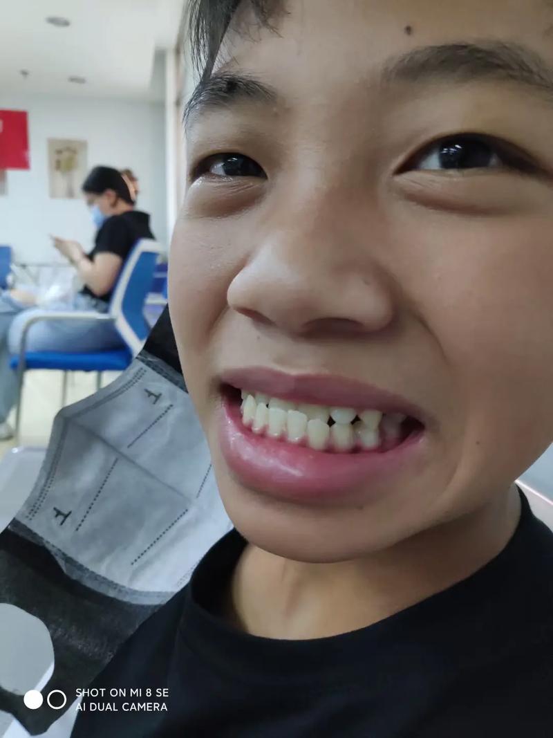 矫正后地包天为何依旧明显？-图2