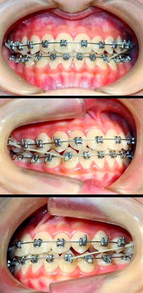 矫正后地包天为何依旧明显？-图3