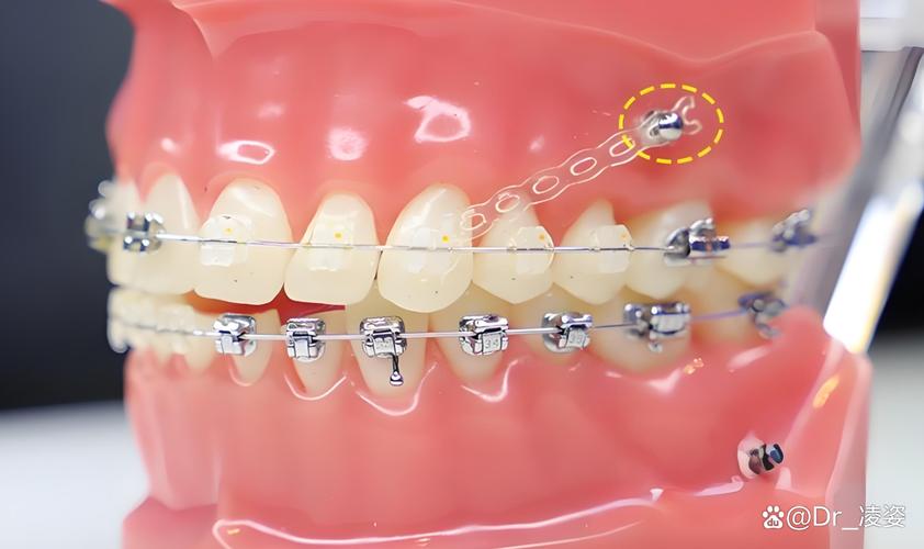 牙齿矫正都要打骨钉吗？-图3