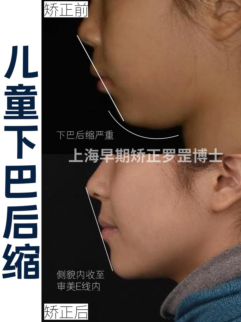 牙齿矫正会影响下巴形态吗？-图3
